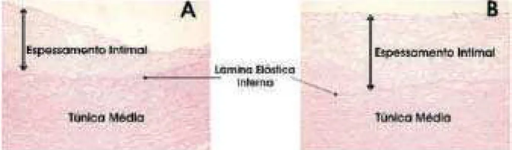 FIGURA 1 - Fotomicrografia de uma secção transversa da parede aórtica proximal (A) e distal (B) 4 semanas após o implante de um stent recoberto com PTFE