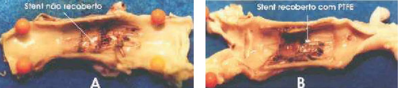 FIGURA 2 - Corte longitudinal de um espécime aórtico retirado 4 semanas após o implante de um stent não recoberto (A) e recoberto com PTFE (B).