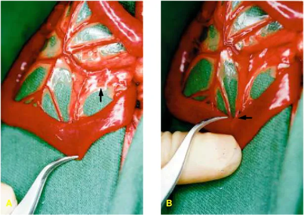 FIGURA  1 –  Identificação do pâncreas no mesentério duodenal (A) e da desembocadura do ducto