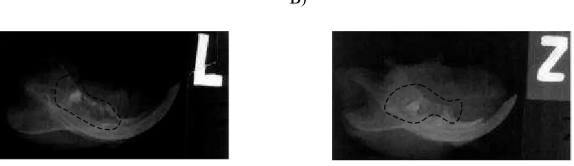 FIGURA 3 - Radiografia periapical da mandíbula direita. A) Área radiolúcida na região das