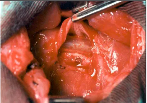 FIGURA 1 - Extensa ressecção de tecido esofágico.