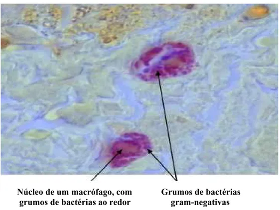 FIGURA 4 - Grumos de bactérias gram-negativas no citoplasma de macrófagos, ao redor de seu núcleo (Gram – 1.000x)corados com HE e Gram, respectivamente.