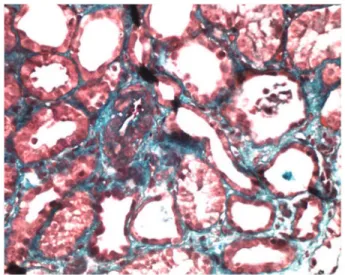 Figure 1. Glomerule with wrinkled loops associated with an ischemic  process (H&amp;E, × 400) 