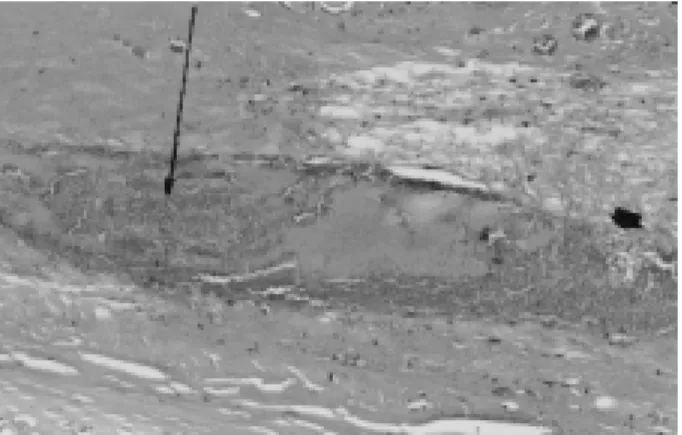 FIGURA 3 - Fotomicrografia mostrando destruição da parede vascular (seta larga) e organização do trombo (seta estreita).