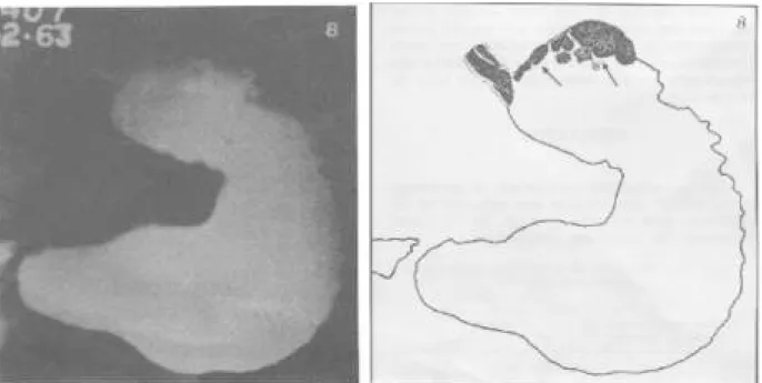 FIGURA 1 – Radiografia contrastada do estômago que mostra alterações da mucosa do fundo gástrico causado por varizes em doente
