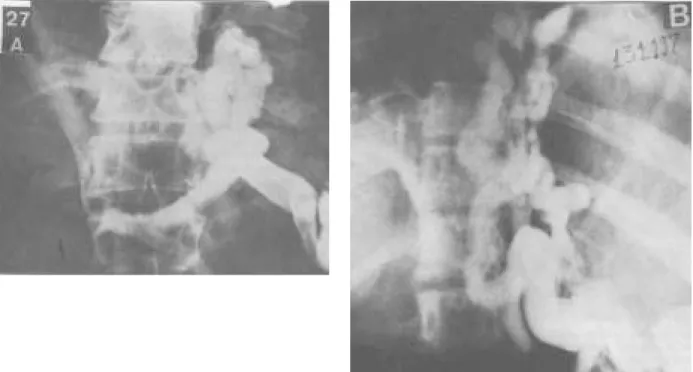 FIGURA 3 – A) Esplenoportografia transparietal de doente esquistossomótico. Pressão venosa intra-esplênica de 250 mm de água.