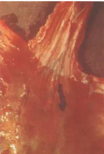 FIGURA 8 – Achado necroscópico de ruptura de variz gástrica