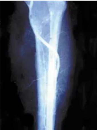 FIGURA 3 - Derivação femoro-tibial anterior.