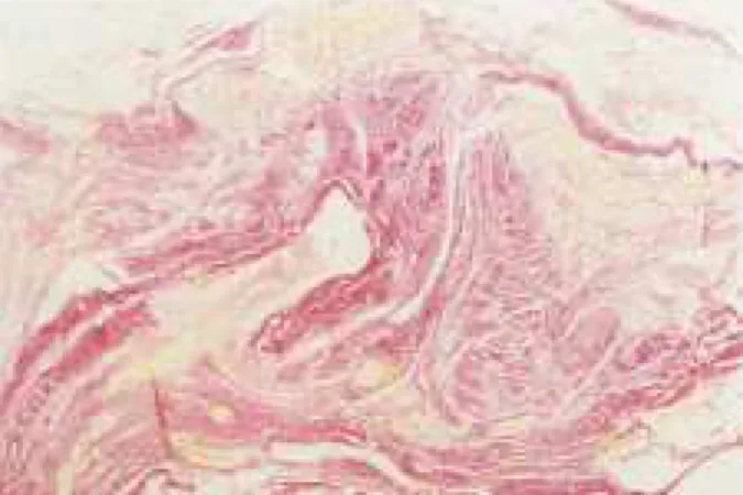 FIGURA 6 – Fotomicrografia mostrando área de sutura contínua na parede abdominal de ratos após 7 dias