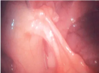 FIGURA 2 - Fotografia mostrando o aspecto videolaparoscópico do epíplon (omento) aderido à prótese de polipropileno na região inguinal