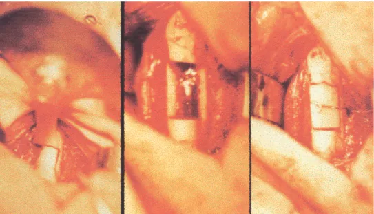 FIGURA 1 – Confecção do defeito ósseo utilizando serra oscilatória e fixação do implante com cerclagem