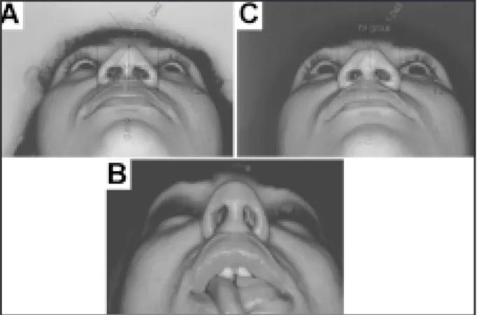 FIGURA 13 - Visão basilar do nariz.