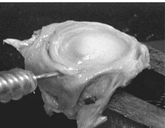 FIGURA 3 – Fixação direta do labrum à glenóide, mostrando fresagem para introdução do parafuso.