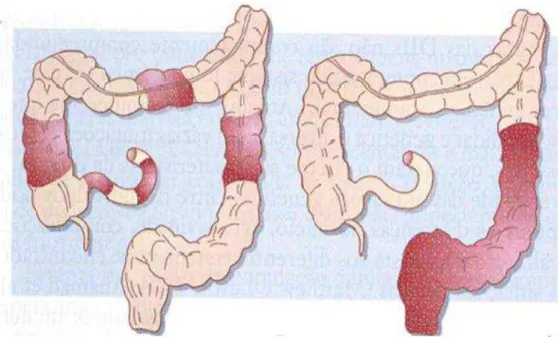 Figura 2  – Doença de Crohn (esquerda) e Colite Ulcerativa (direita) 