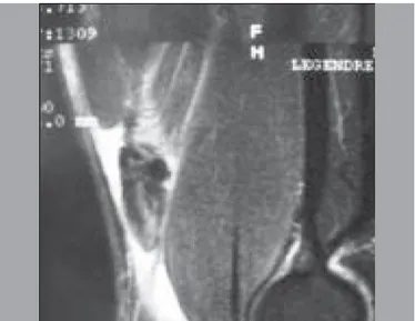 Figura 2. Corte sagital de RNM em T2 com puptura insercional do bíceps distal.