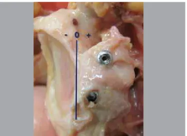 Figura 6. Lesão do nervo supraescapular pelo parafuso de fixação do 