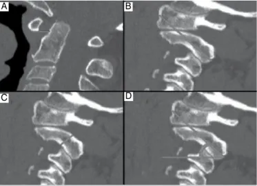 Tabela 1. Valores Médios obtidos para cada lado. Comprimento do  pedículo de C2 até  a massa de C1 Espessura do  pedículo de C2  Ângulo de ataque do parafuso com a horizontal Distância do  arco de C1 ao Odontóide Direita 23,08 mm  (±2,40) 6,46 mm (±0,94) 4