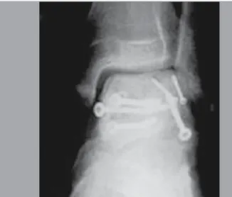 Figura 2b. A radiografia lateral mostrou incongruência articular, osteoesclero-