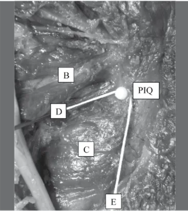 Figura 3b. Forma de mensuração da profundidade P. (A) Tendão conjunto,  (B) Músculo quadrado femoral, (C) Linha que tangência o bordo posterior do  músculo quadrado femoral