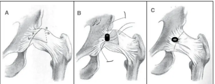Figura 2. (A) abertura da cápsula articular na letra; (B) inserção da 