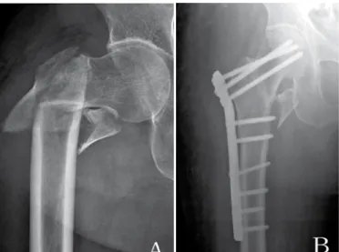 Figura 1.  Caso  1  (A)  Mulher,  78  anos,  Seinsheimer  V,  radiografia AP  antes da cirurgia
