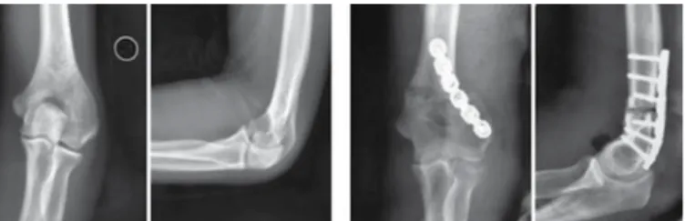Figura 1. Método de osteotomia: o ângulo varo (X) do lado deformado e 