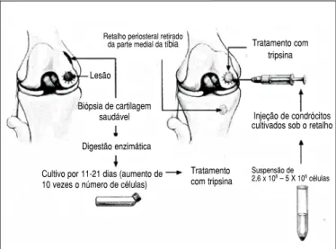 Figura 1: Desenho esquemático do procedimento do transplante autólo- autólo-go de condrócitos (Brittberg, 1994)