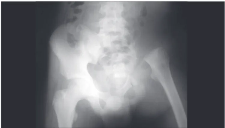 Figura 1. Radiografia controle pós-operatoria de bacia mostrando a  ressecção de toda a hemibacia esquerda e a adaptação do membro  inferior na deambulação com o sacro.
