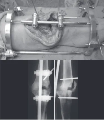 Figura 1. (A) Aspecto trans-operatório da artrodese com fixador externo de  semi-anéis