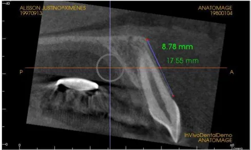 Figura 2: Altura do corte coronal para aferir a densidade óptica. 