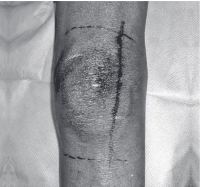 Figura  1 – demarcação da incisão no joelho esquerdo. a linha inteira  corresponde à incisão inicial e a linha tracejada mostra as incisões  sub-sequentes.