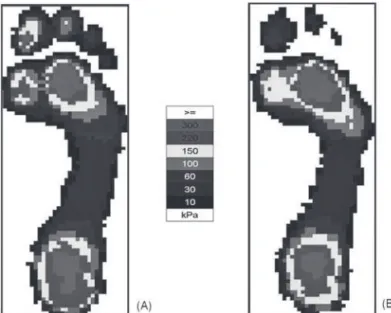 Figura  1  –  Impressão  plantar  do  pé  esquerdo  de  uma  paciente  com 