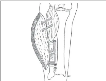 Figura 5 – Nota-se a ferida infectada e revestimento cutâneo cicatricial 