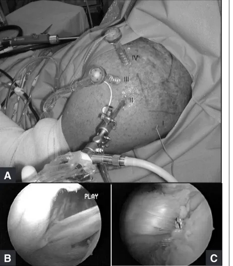 Figura  4 C – Imagem intra-operatória de cirurgia artroscópica mostrando 
