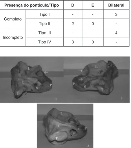 Tabela 5 – Projeções Laterais Proximal e Distal do Sulco da artéria vertebral