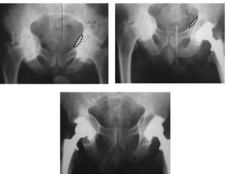 Figura 5 – Imagens  radiográficas demonstrando  evolução  de  10 anos   de  paciente com  Otopelve  bilateral  tratado  com  ATQ  tipo  CO-10   bilateralmente