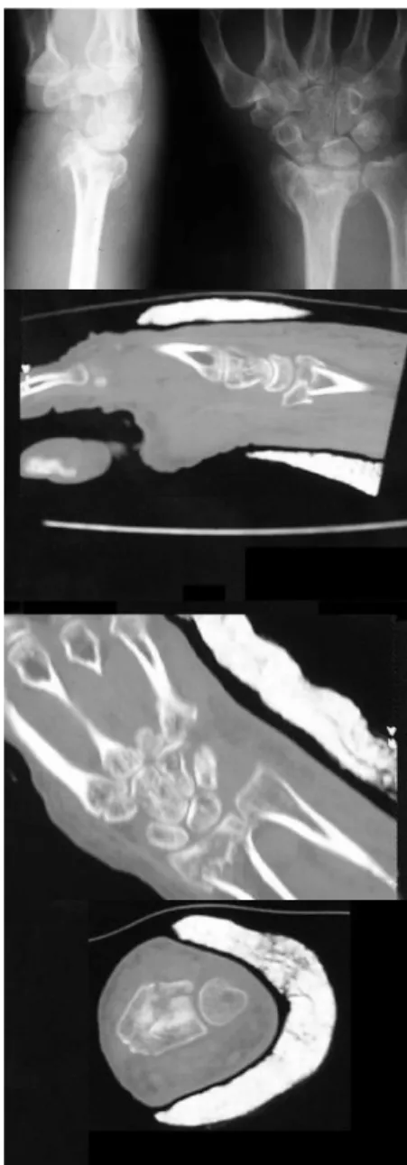 Figura  1  -  Radiografia  posteroanterior  e  perfil  de  punho  e  tomografia 