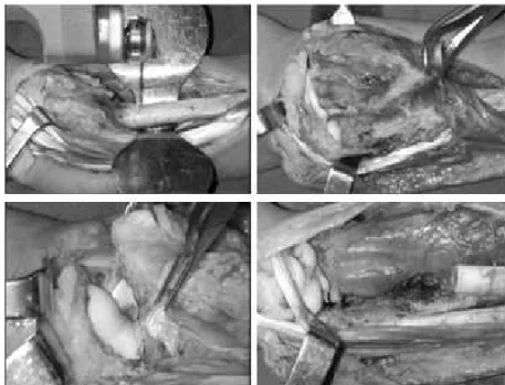 Figura 1 - Acesso arciforme ao segmento distal do rádio que inicia 1,5 cm  distal à estilóide na dirigindo-se lateralmente contornando a estilóide radial;  prossegue em sentido proximal na extensão necessária à ressecção com  margem oncológica.