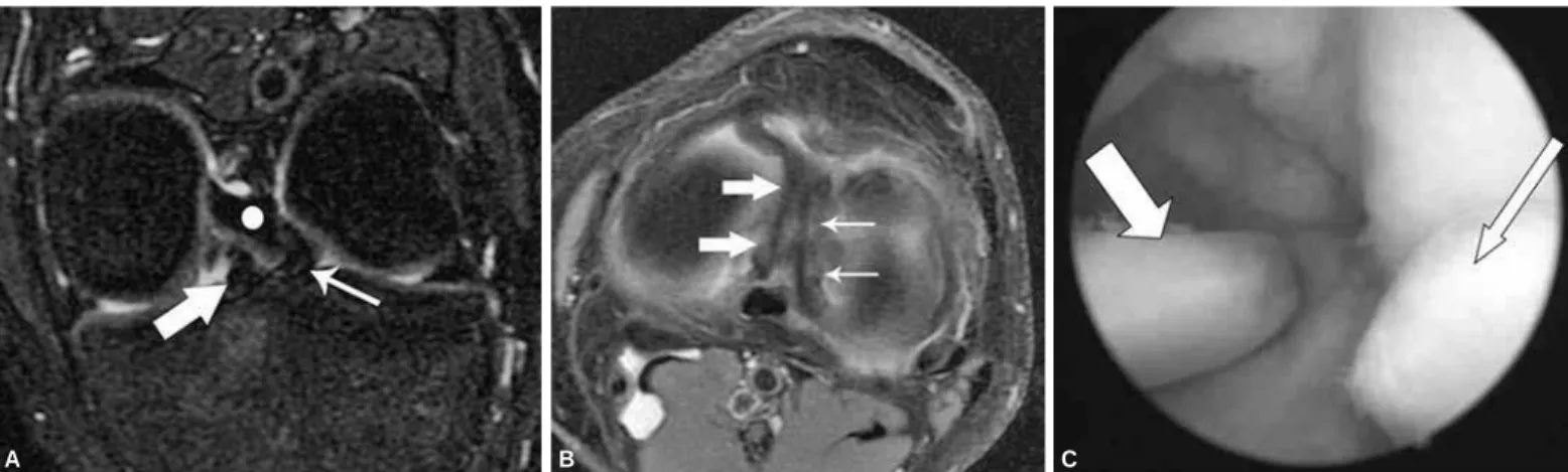 Figura 2 – Imagem coronal oblíqua (A) e axial (B) ponderada em T2 com saturação de gordura mostrando os fragmentos meniscais migrados para a região 