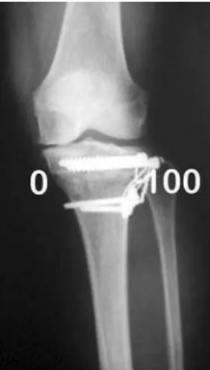 Figura 2 - Radiografia pós-operatório incidência antero-posterior mostrando 