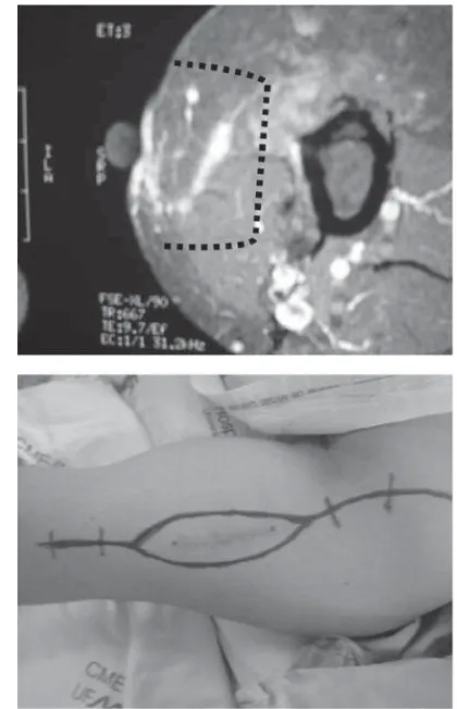 Figura 1 - Planejamento cirúrgico pré-operatório de um sarcoma submetido  à ressecção prévia inadvertida (A – Ressonância magnética do braço com  demarcação da área de ampliação; B – marcação do acesso cirúrgico) 