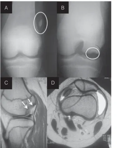 Figura 2 - A)Lesão tipo cratera de osteocondrite dissecante do joelho no 