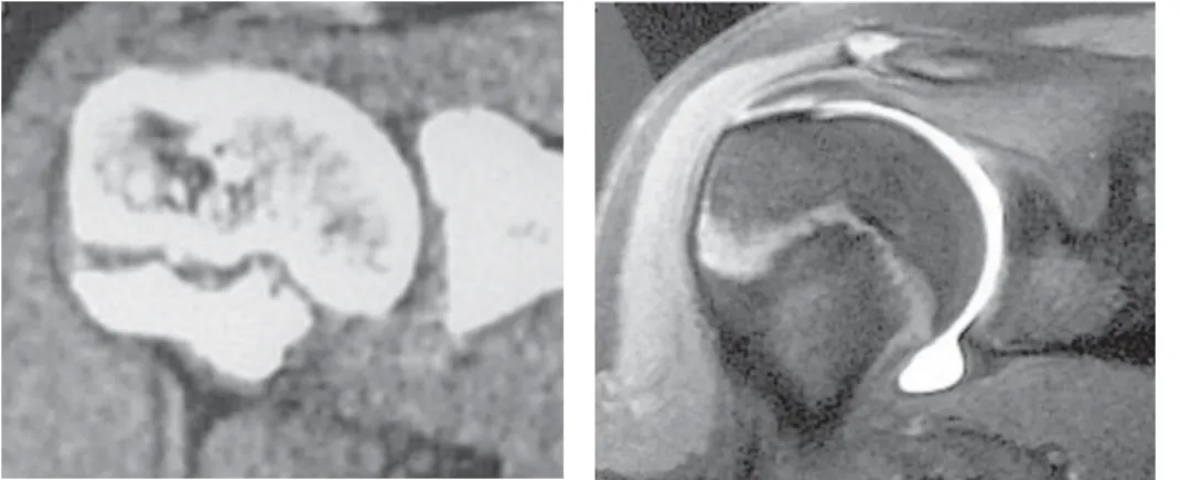 Figura  2 -  Radiografia na posição axilar do Ombro direito, mostrando alargamento da fise de crescimento do terço proximal do úmero e irregularidades no seu contorno.