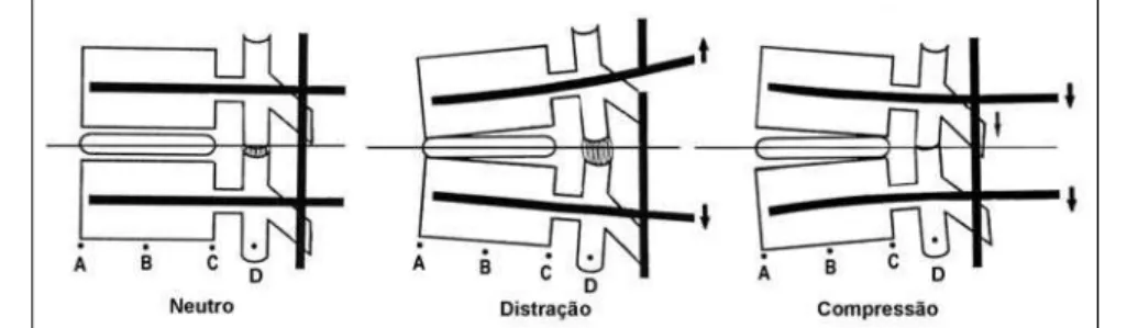 Figura 4 - Desenho ilustrando os efeitos da aplicação de compressão ou distração 