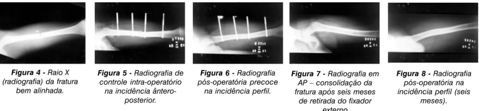 Figura 4 - Raio X (radiografia) da fratura bem alinhada. Figura 5 - Radiografia decontrole intra-operatório na incidência  ântero-posterior