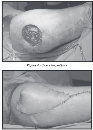 Figura 2 - Úlcera trocantérica após debridamento