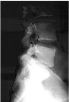 Figura 1 - Exame radiográfico em perfil de coluna lombosacra mostrando deslocamento posterior