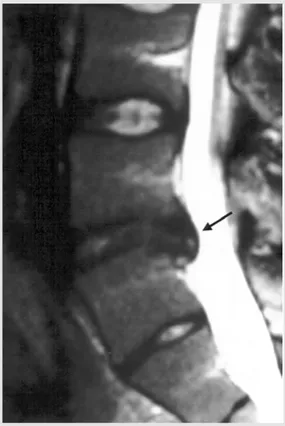 Figura 4 - Corte sagital de RM lombo-sacra mostrando o local da avulsão óssea no planalto póstero-superior de L5 e a hérnia discal insinuada