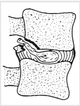 Figura 5 - Desenho esquemático mostrando avulsão do fragmento ósseo da placa terminal