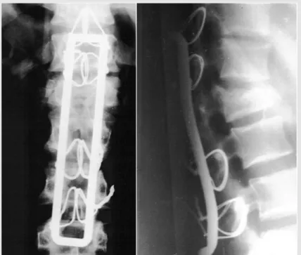 Figura 2- Fotografias de radiografias pós-operatórias da coluna lombar e